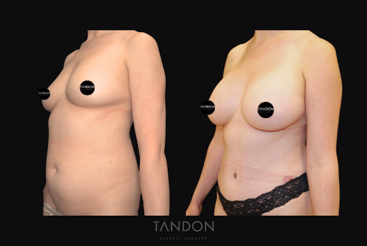 Breast Augmentation Before & After Gallery - Patient 388333 - Image 4