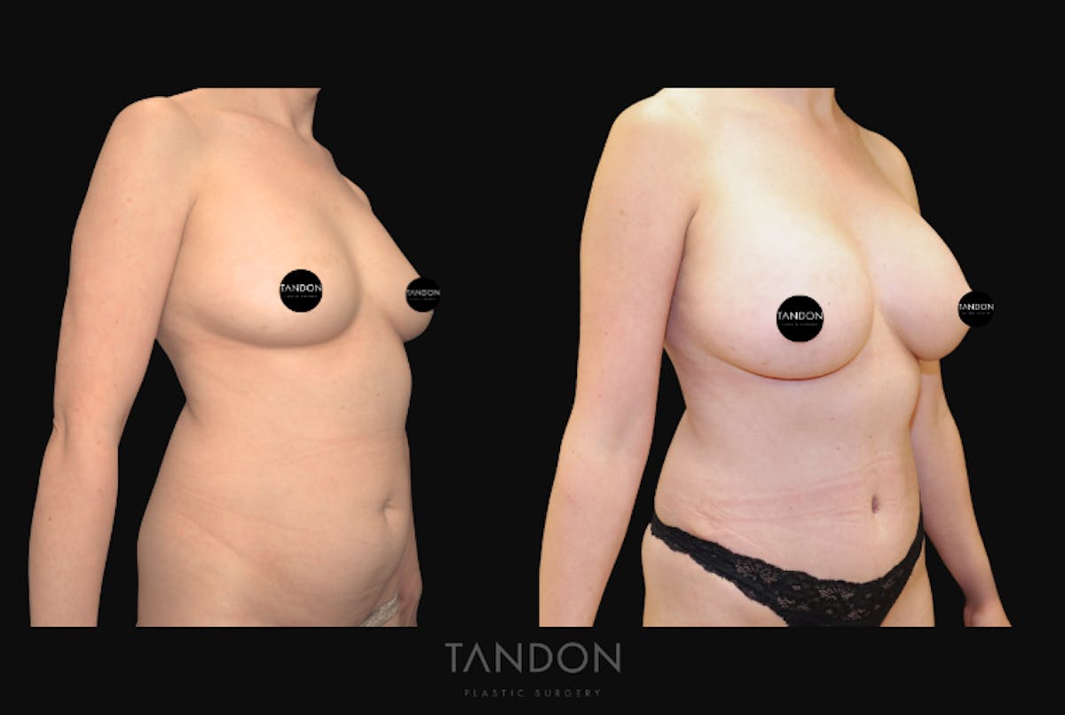 Breast Augmentation Before & After Gallery - Patient 388333 - Image 2