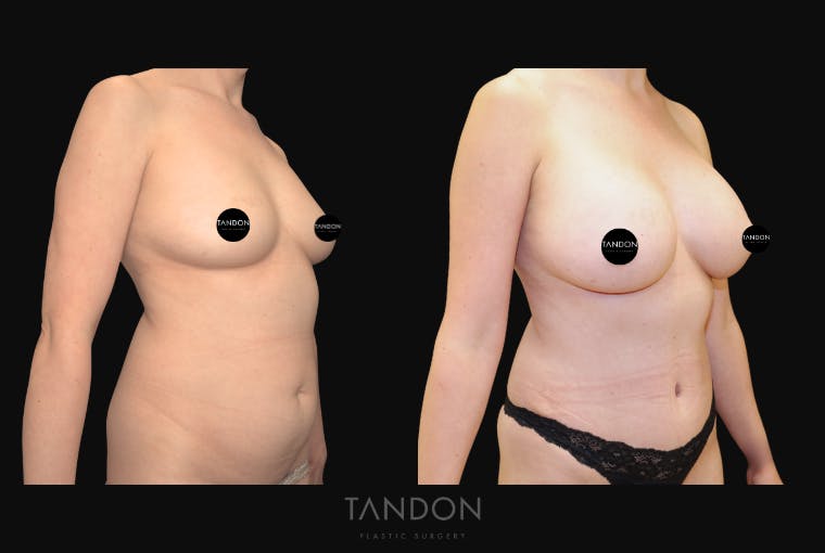 Breast Augmentation Before & After Gallery - Patient 388333 - Image 2