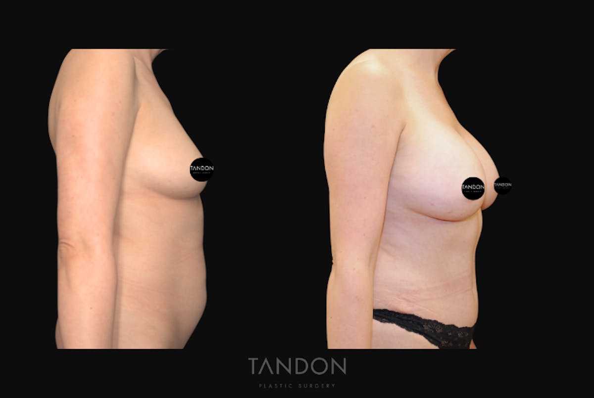 Breast Augmentation Before & After Gallery - Patient 388333 - Image 3