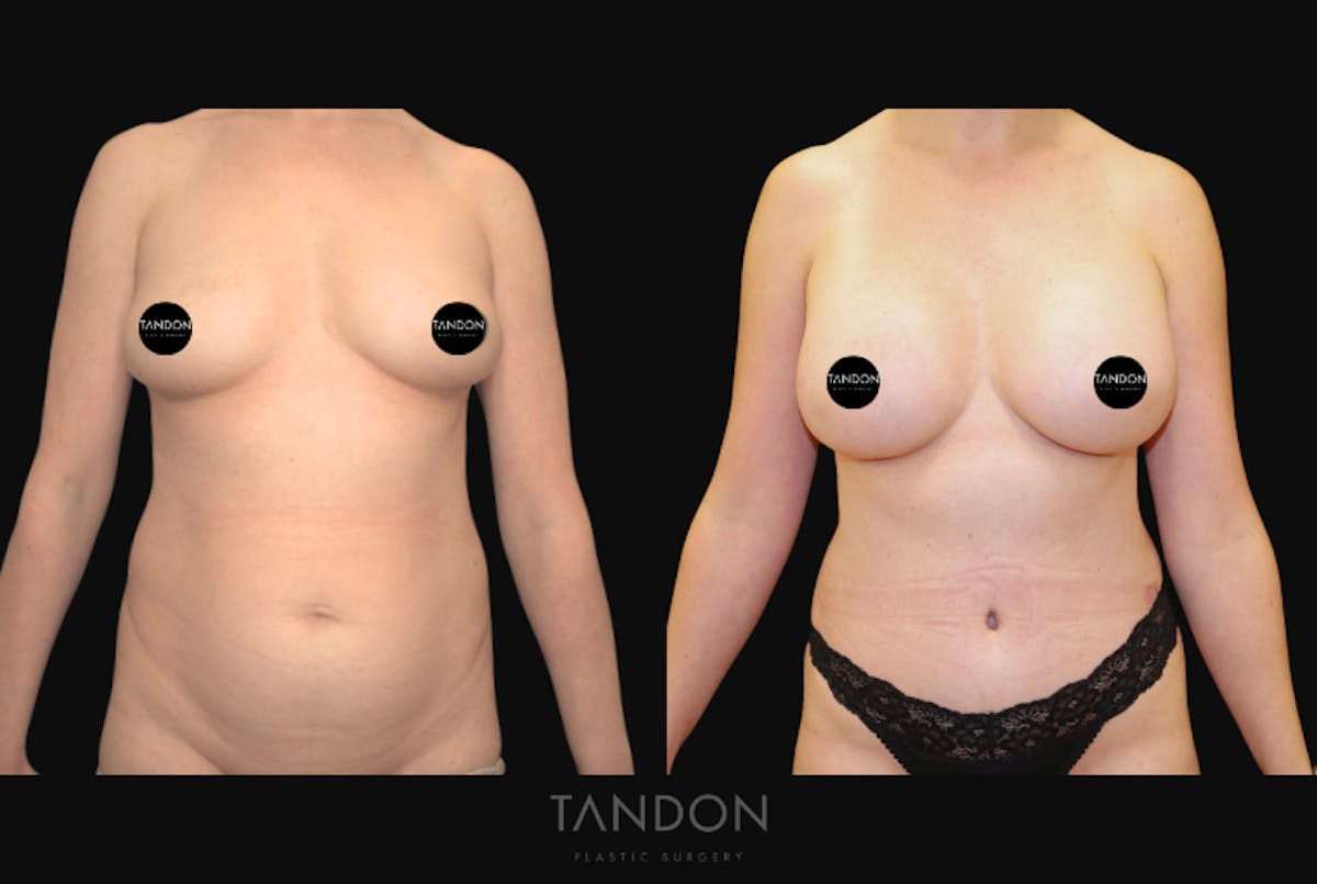 Breast Augmentation Before & After Gallery - Patient 388333 - Image 1