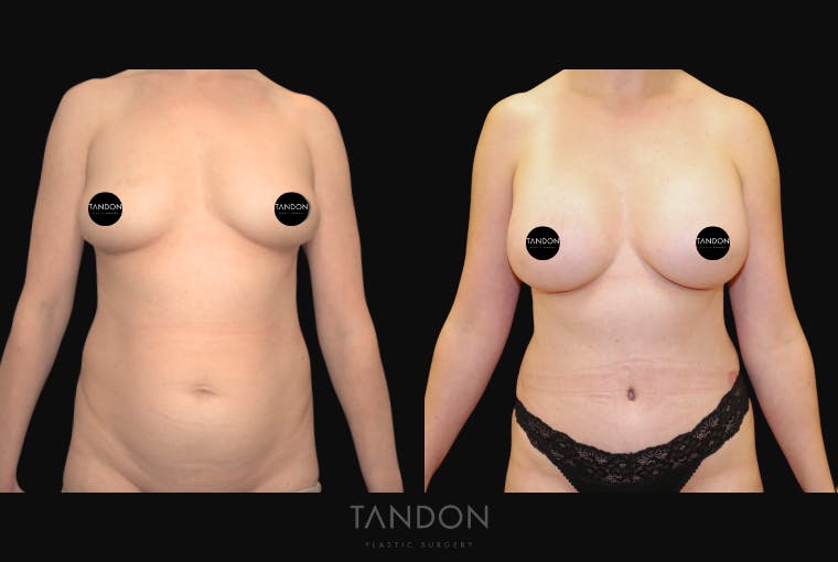 Breast Augmentation Before & After Gallery - Patient 388333 - Image 1