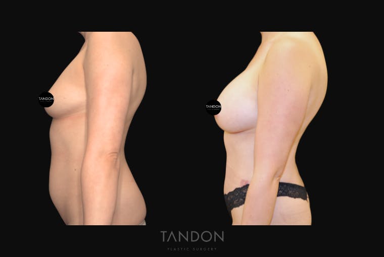 Breast Augmentation Before & After Gallery - Patient 388333 - Image 5