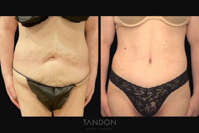 Abdominoplasty (Tummy Tuck) Before & After Gallery - Patient 172149 - Image 1