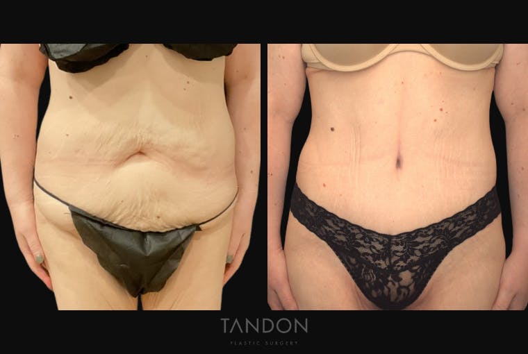 Abdominoplasty (Tummy Tuck) Before & After Gallery - Patient 172149 - Image 1