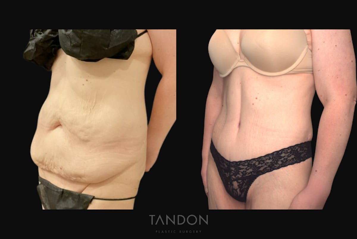Abdominoplasty (Tummy Tuck) Before & After Gallery - Patient 172149 - Image 4