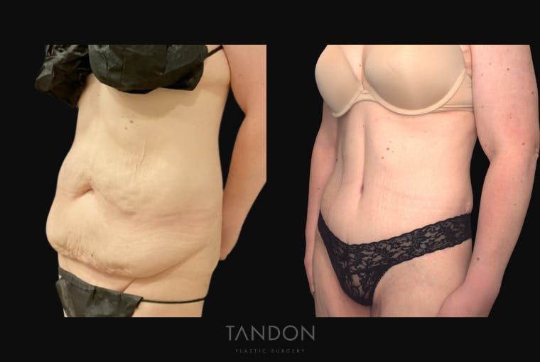 Abdominoplasty (Tummy Tuck) Before & After Gallery - Patient 172149 - Image 4