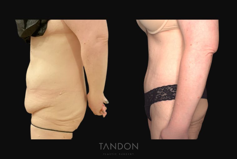 Abdominoplasty (Tummy Tuck) Before & After Gallery - Patient 172149 - Image 5