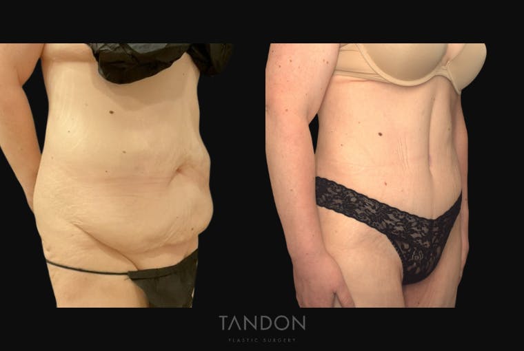 Abdominoplasty (Tummy Tuck) Before & After Gallery - Patient 172149 - Image 2