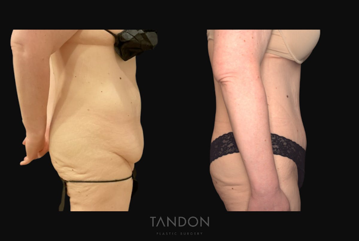 Abdominoplasty (Tummy Tuck) Before & After Gallery - Patient 172149 - Image 3