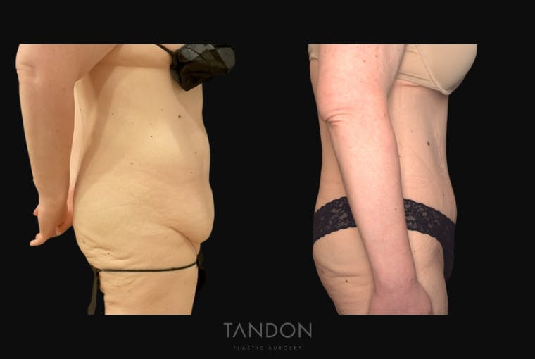 Abdominoplasty (Tummy Tuck) Before & After Gallery - Patient 172149 - Image 3