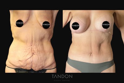 Breast Augmentation Before & After Gallery - Patient 356331 - Image 1