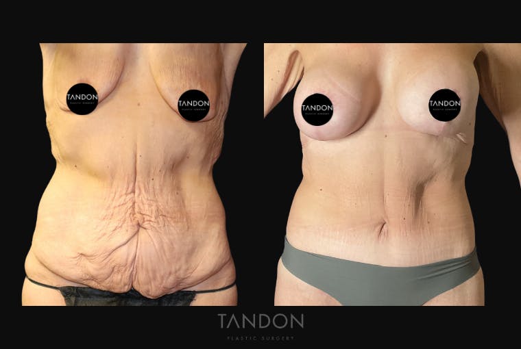 Breast Augmentation Before & After Gallery - Patient 356331 - Image 1