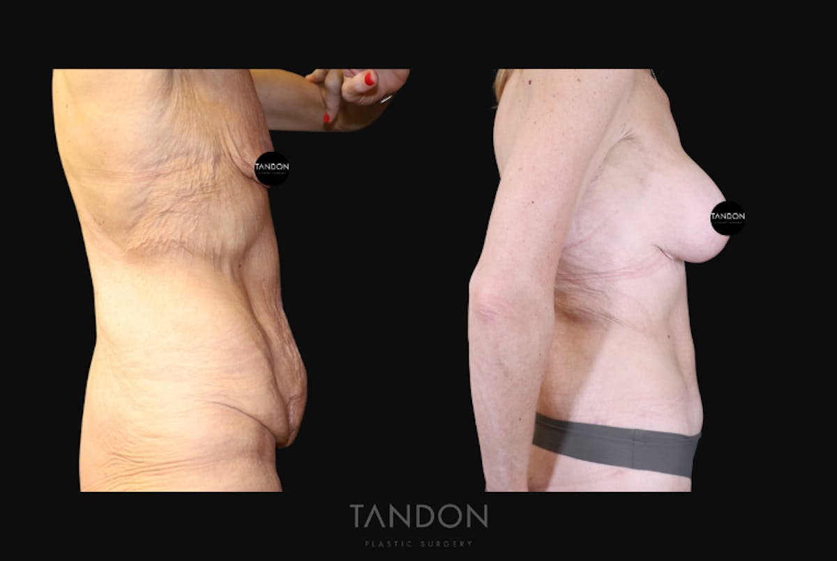 Abdominoplasty (Tummy Tuck) Before & After Gallery - Patient 293581 - Image 3