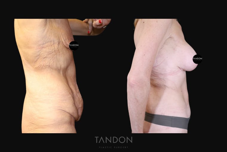 Breast Augmentation Before & After Gallery - Patient 356331 - Image 3