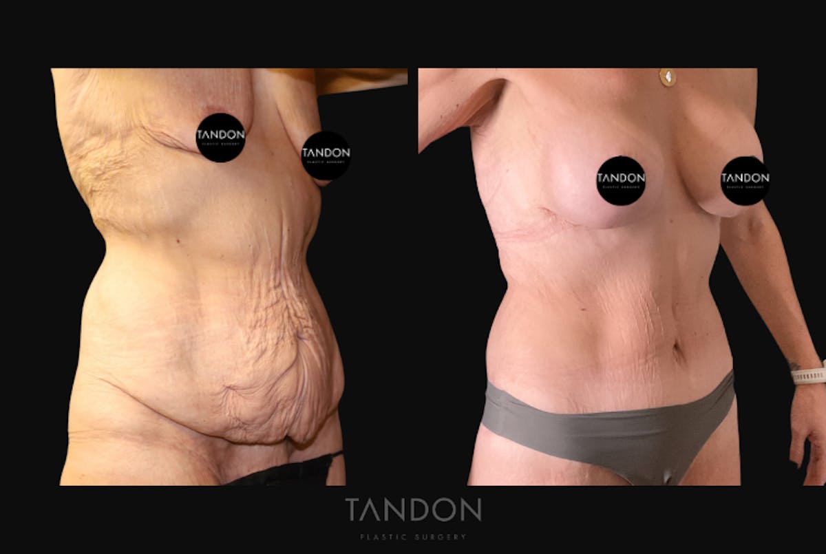 Abdominoplasty (Tummy Tuck) Before & After Gallery - Patient 293581 - Image 2