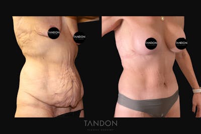 Breast Lift Before & After Gallery - Patient 417925 - Image 2