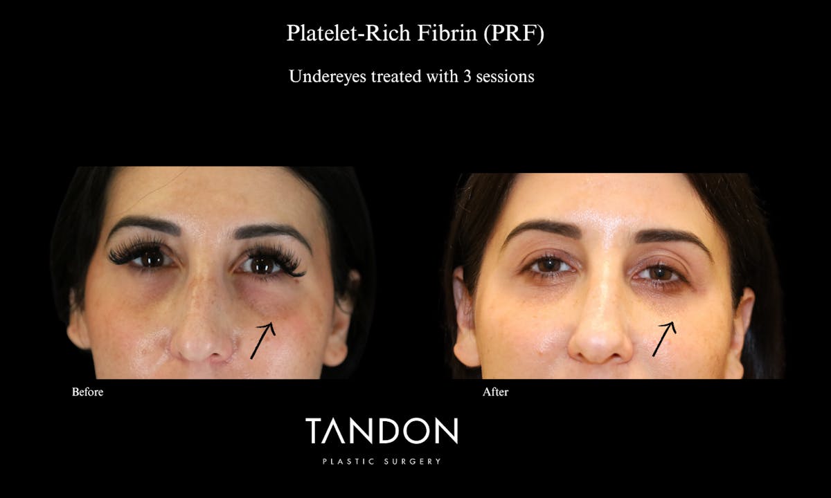 PRF Before & After Gallery - Patient 992202 - Image 1