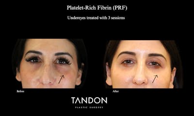 PRF Before & After Gallery - Patient 992202 - Image 1