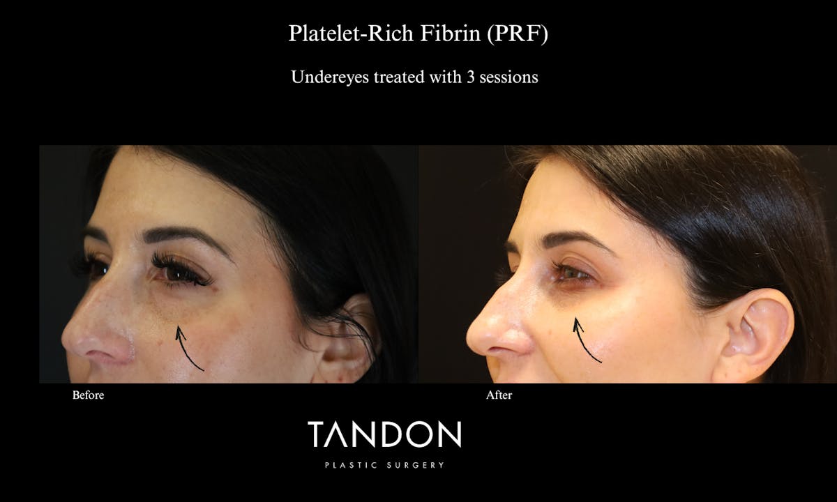 PRF Before & After Gallery - Patient 992202 - Image 2