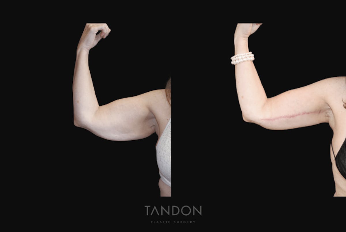 Arm Lift (Brachioplasty) Before & After Gallery - Patient 260926 - Image 2