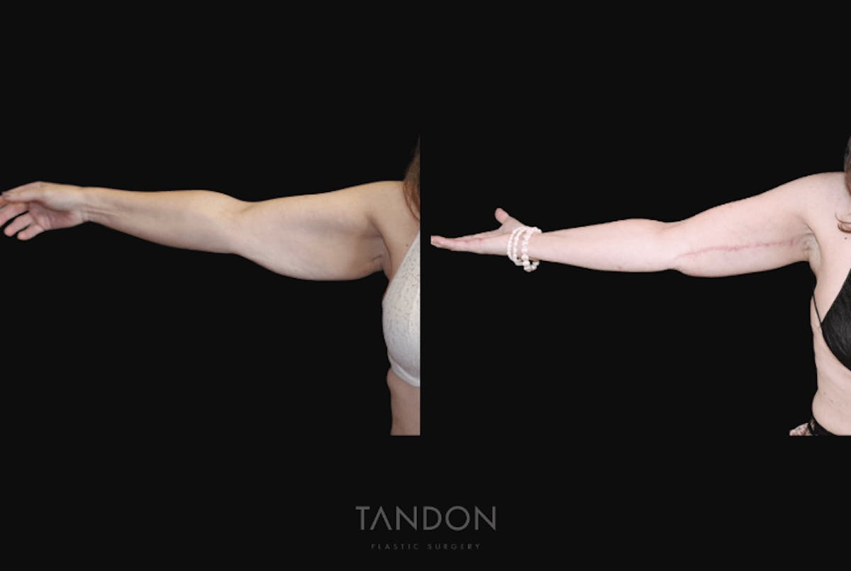 Arm Lift (Brachioplasty) Before & After Gallery - Patient 260926 - Image 1
