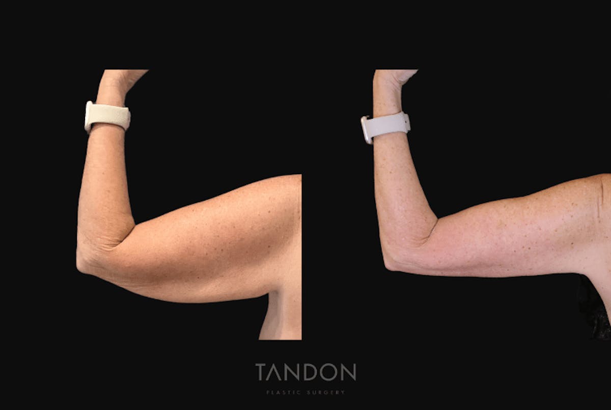 Arm Lift (Brachioplasty) Before & After Gallery - Patient 301370 - Image 4