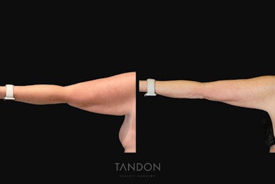 Arm Lift (Brachioplasty) Before & After Gallery - Patient 301370 - Image 1