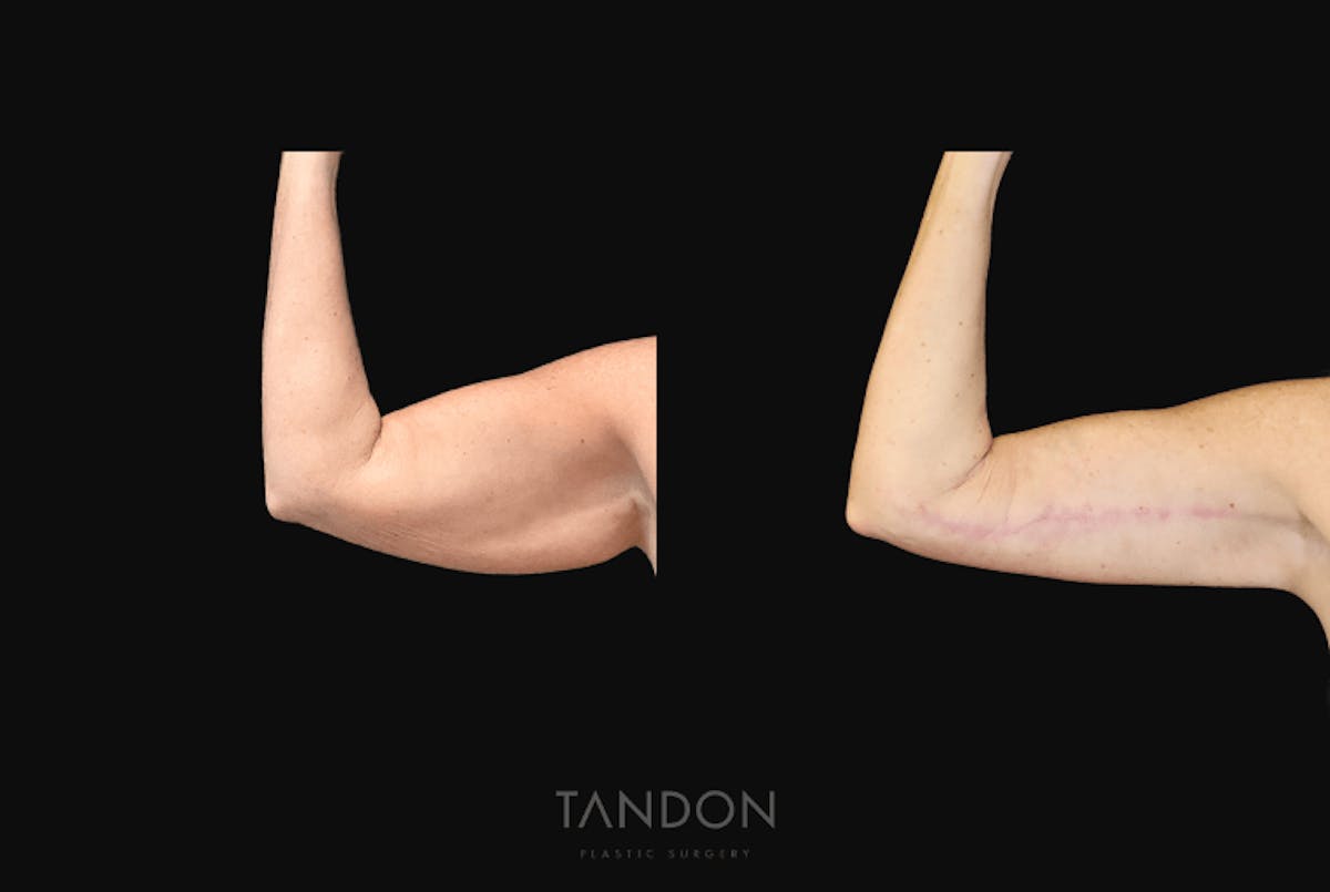 Arm Lift (Brachioplasty) Before & After Gallery - Patient 301370 - Image 3
