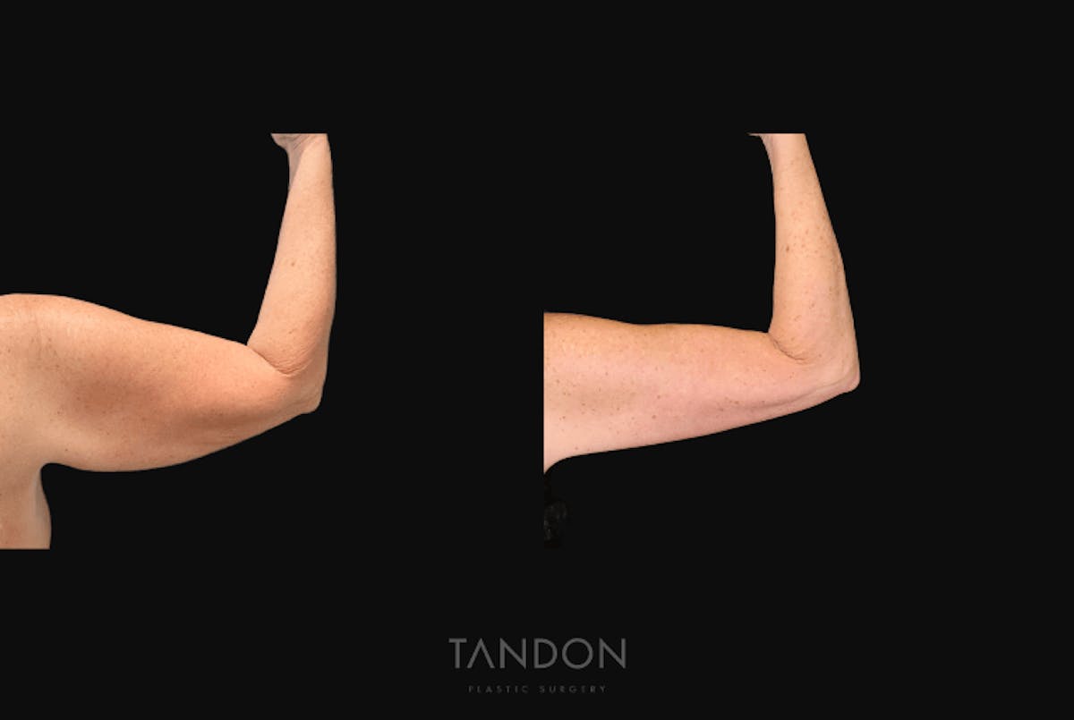 Arm Lift (Brachioplasty) Before & After Gallery - Patient 301370 - Image 8