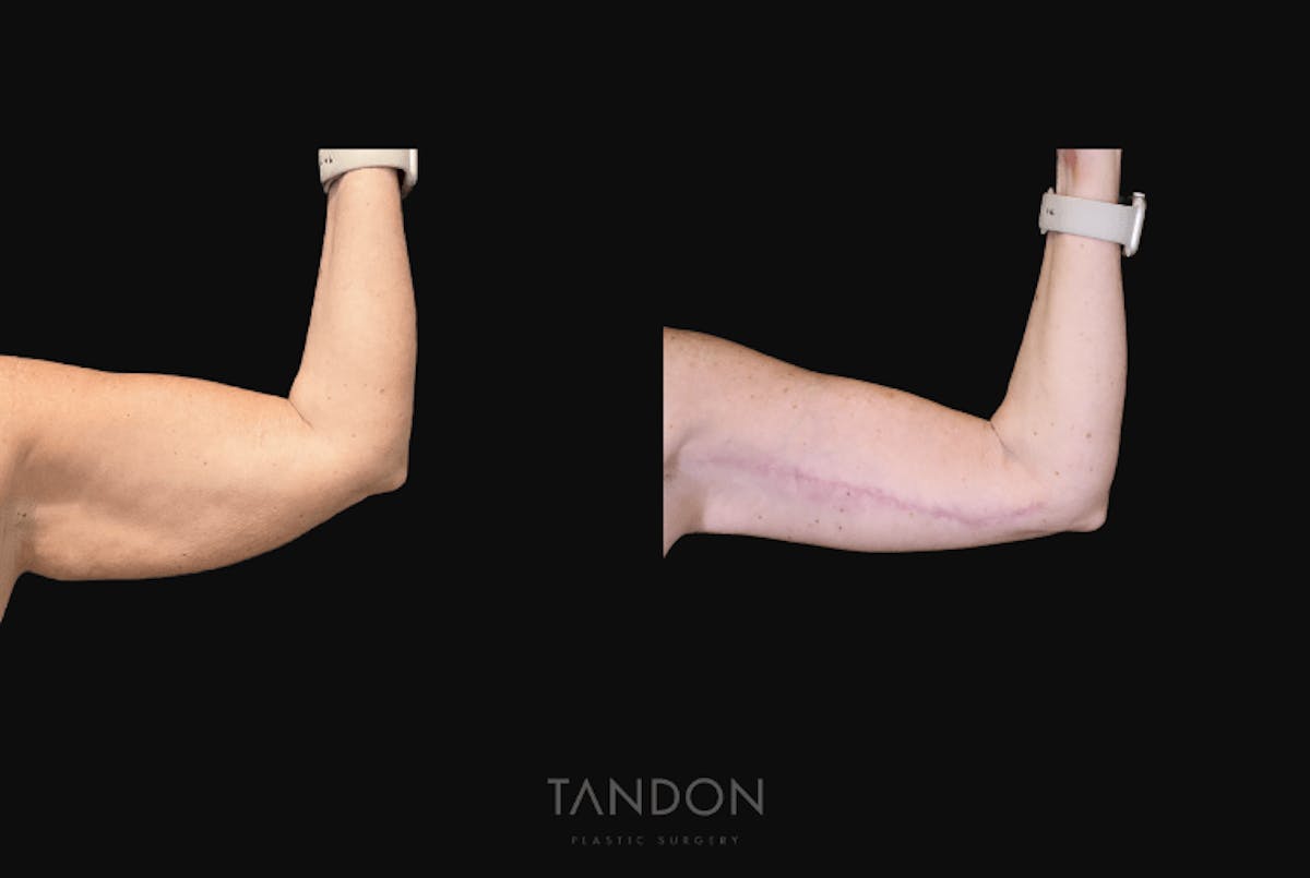 Arm Lift (Brachioplasty) Before & After Gallery - Patient 301370 - Image 7