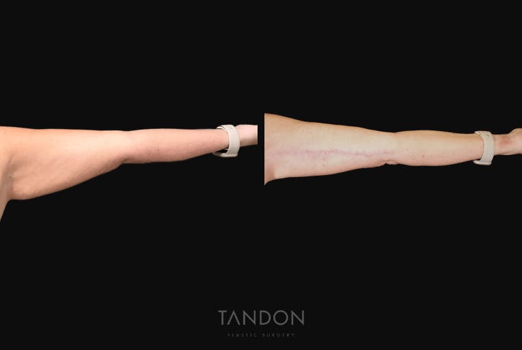 Arm Lift (Brachioplasty) Before & After Gallery - Patient 301370 - Image 5