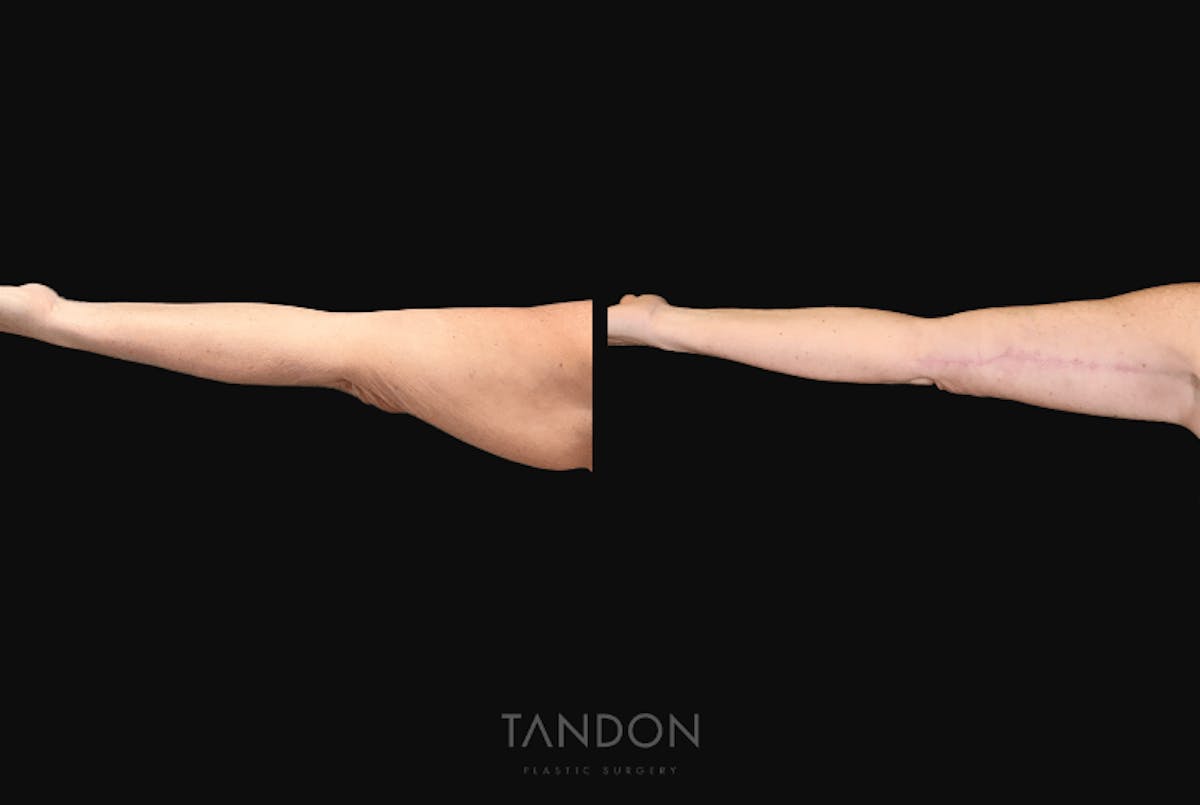 Arm Lift (Brachioplasty) Before & After Gallery - Patient 301370 - Image 2