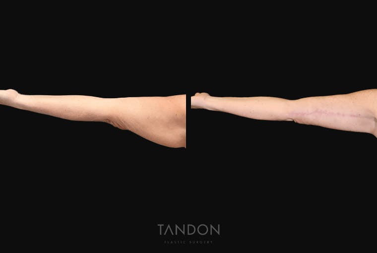 Arm Lift (Brachioplasty) Before & After Gallery - Patient 301370 - Image 2