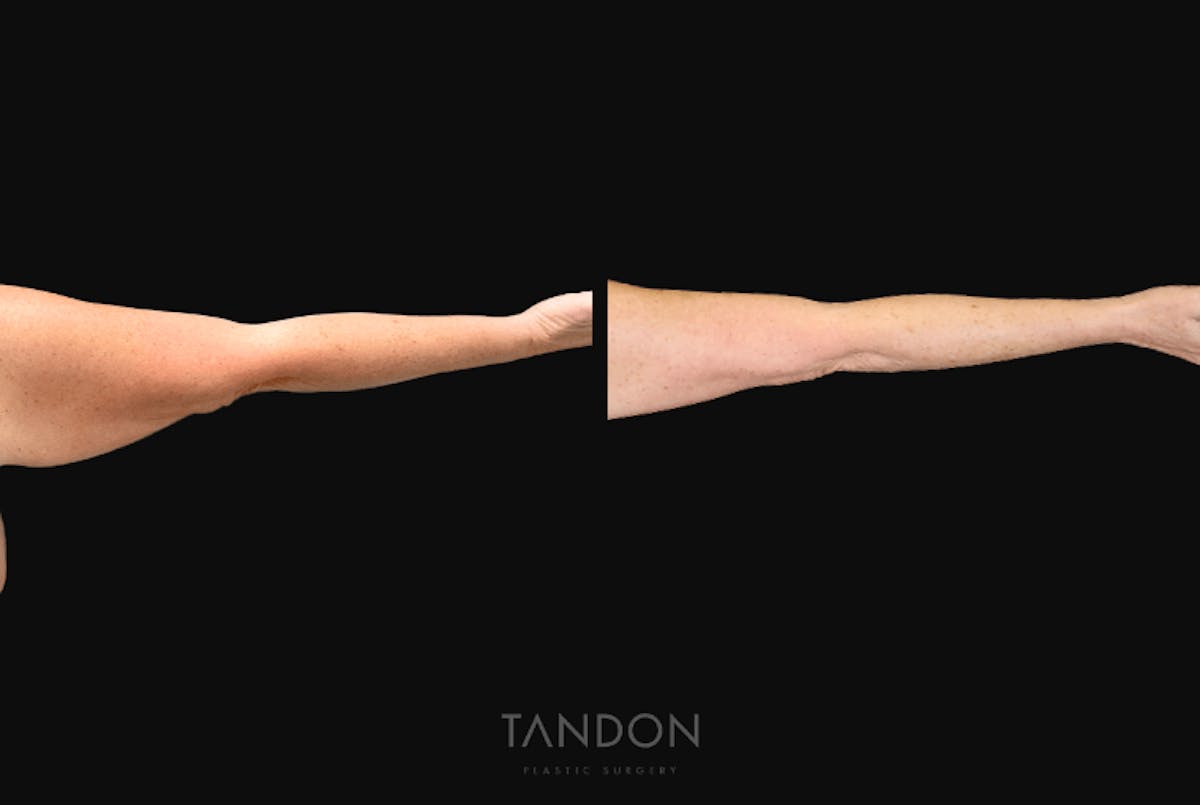 Arm Lift (Brachioplasty) Before & After Gallery - Patient 301370 - Image 6