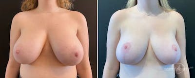Breast Reduction Before & After Gallery - Patient 158665 - Image 1