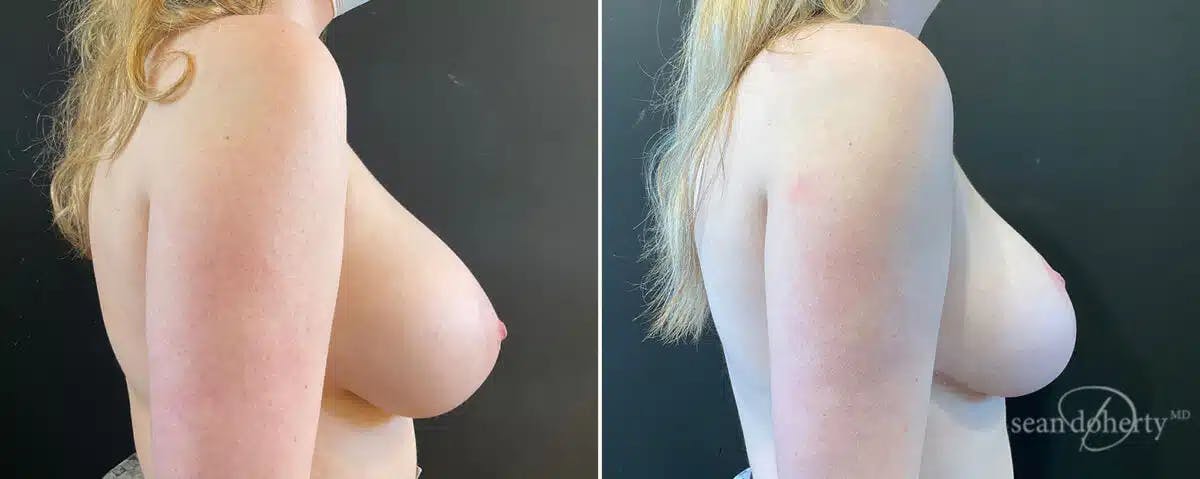 Breast Reduction Before & After Gallery - Patient 158665 - Image 3