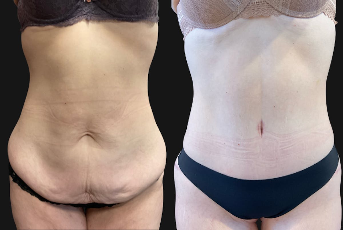 Abdominoplasty (Tummy Tuck) Before & After Gallery - Patient 172460 - Image 1