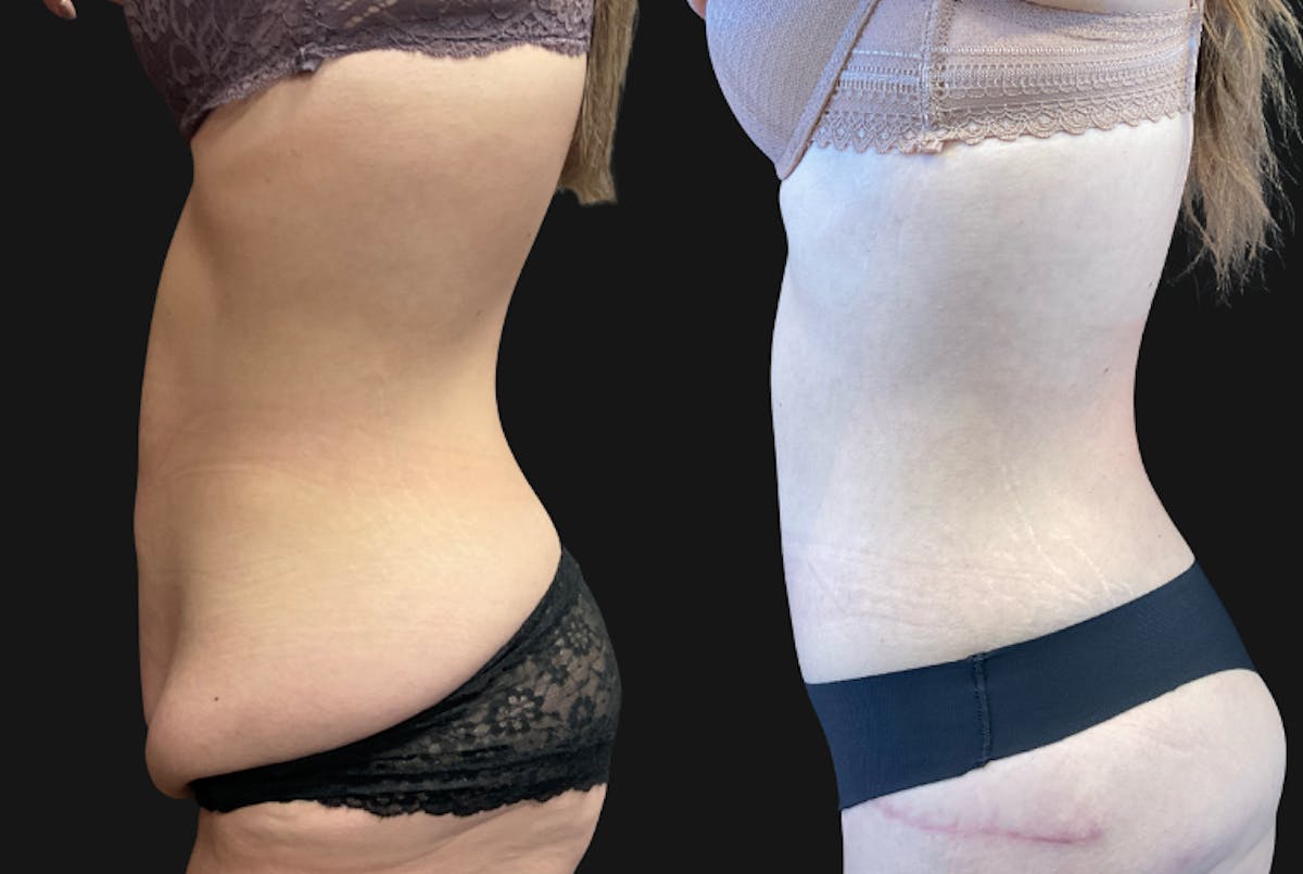 Abdominoplasty (Tummy Tuck) Before & After Gallery - Patient 172460 - Image 2