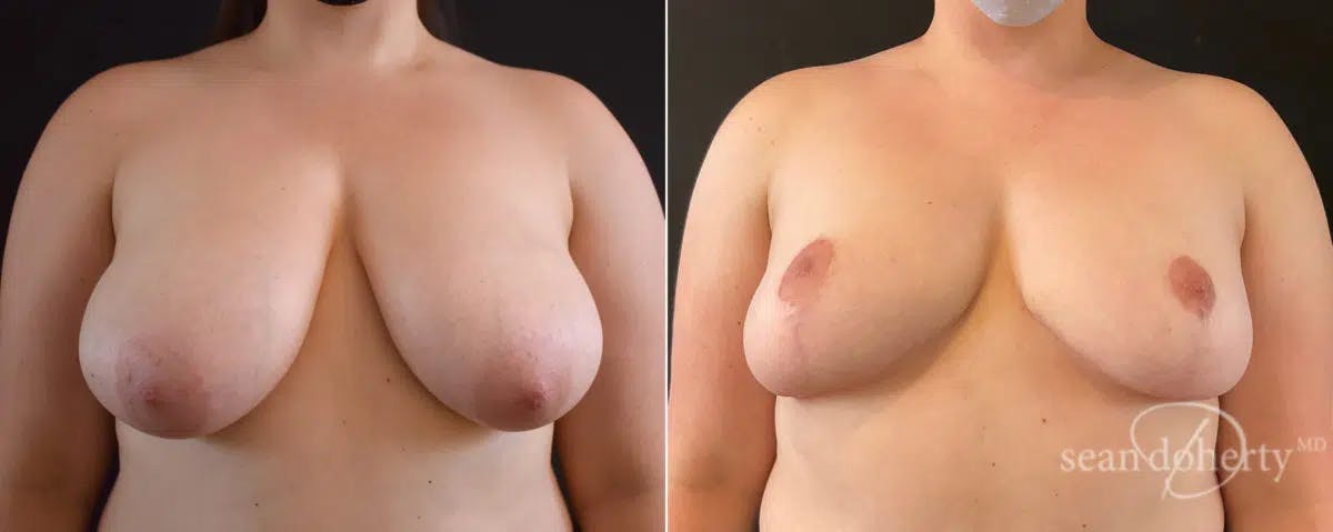 Breast Reduction Before & After Gallery - Patient 423426 - Image 1