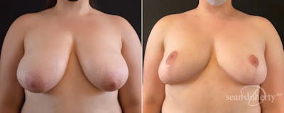 Breast Reduction Before & After Gallery - Patient 423426 - Image 1