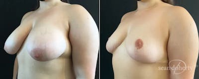Breast Reduction Before & After Gallery - Patient 423426 - Image 2