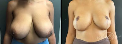 Breast Reduction Before & After Gallery - Patient 182170 - Image 1