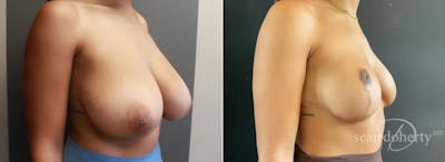 Breast Reduction Before & After Gallery - Patient 182170 - Image 2