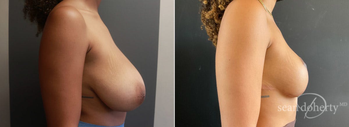 Breast Reduction Before & After Gallery - Patient 182170 - Image 3