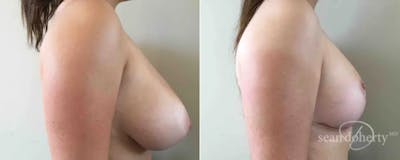 Breast Reduction Before & After Gallery - Patient 420889 - Image 2