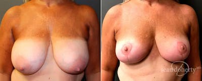 Breast Reduction Before & After Gallery - Patient 224331 - Image 1