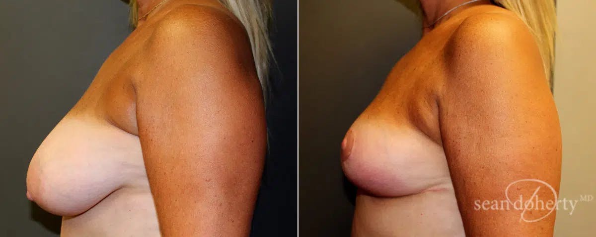 Breast Reduction Before & After Gallery - Patient 224331 - Image 3