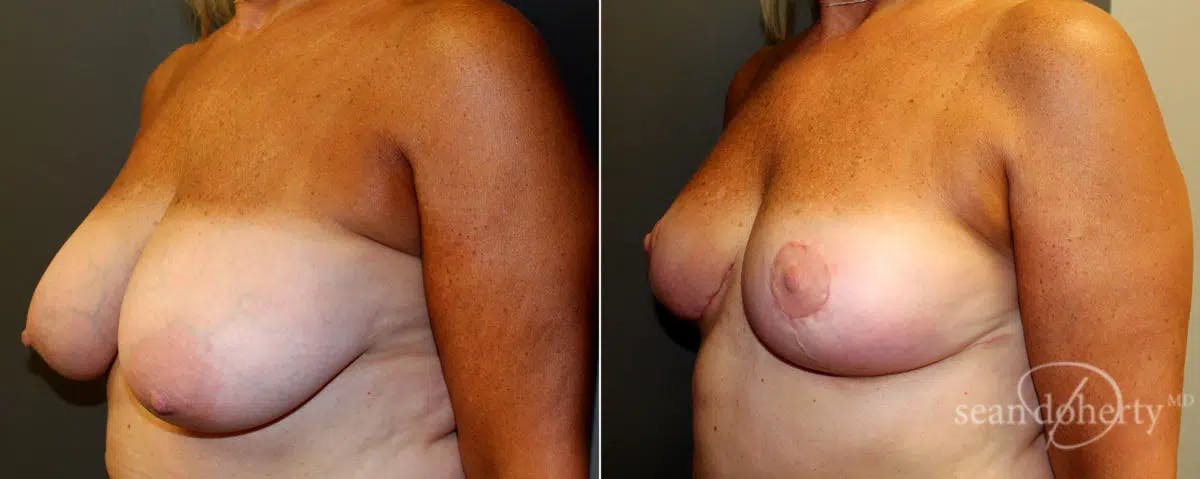 Breast Reduction Before & After Gallery - Patient 224331 - Image 2