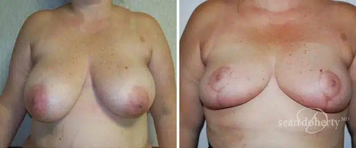 Breast Reduction Before & After Gallery - Patient 726379 - Image 1